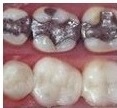 Silver or white fillings