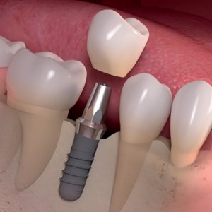 Dental Implants