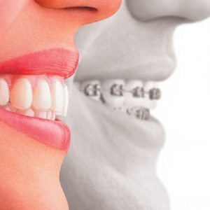 Invisalign2